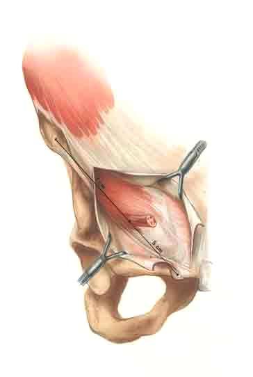 Nyhus and Condons Hernia, Fifth Edition, edited by Robert J Fitzgibbons, Jr. and A. Gerson Greenburg.