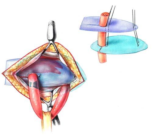 Tension-Free, Sutureless, Preshaped Mesh Herniopiasty 163 RYSUNEK 15.5. Tylną ścianę kanału zamknięto nad siatką T5.