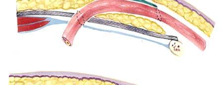 B- W przypadku, gdy powrózek nasienny jest w tkance podskórnej, (technika Trabucci) przyśrodkowa część tylnej ściany kanłu chroniona jest przed nawrotem potrójną warstwę (powięź poprzeczna, siatka,