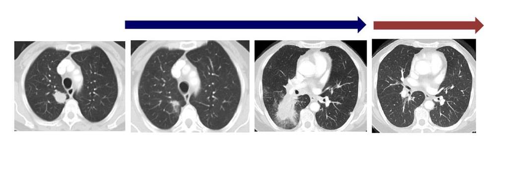 INHIBITORY TYROZYNOWEJ KINAZY EGFR POSTĘPOWANIE W PRZYPADKU OPORNOŚCI Erlotynib