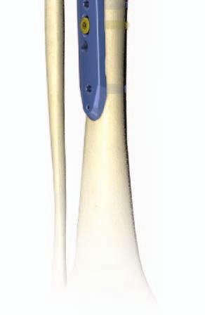 BLOKOWANA
