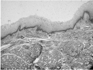 wargowa nabłonek wielowarstwowy płaski nierogowaciejący lub rogowaciejący