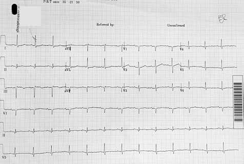 Badanie elektrokardiograficzne wykonane przy powtórnym przyjęciu pacjentki; widoczne cechy przebytego zawału ściany dolnej OPIS PRZYPADKU Pacjentka w wieku 75 lat, z wieloletnim wywiadem nadciśnienia