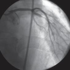 Dwukrotna angioplastyka wieńcowa z powodu dwukrotnego ostrego zespołu wieńcowego 729 Rycina 1.