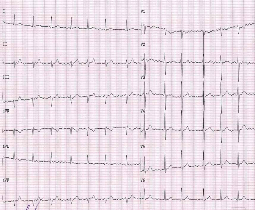 RYCINA 1 EKG przed ablacją. Migotanie przedsionków z rytmem komór około 95/min. Fala migotania o cyklu około 110 ms dodatnia w odprowadzeniach II, III, V 1. Lewogram. Wąskie zespoły QRS (98 ms).