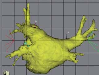 RYCINA 5 Mapa potencjałowa lewego przedsionka w projekcji PA nałożona za pomocą opcji MERGE na obraz TK.