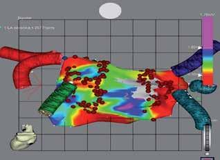 RYCINA 4 Mapa potencjałowa lewego przedsionka w projekcji AP nałożona za pomocą opcji MERGE na obraz TK.