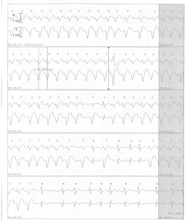 RYCINA 21 Telemetryczny zapis grubofalistego AF z okresowym AT z rytmem komór z szerokimi zespołami QRS (blok odnogi podczas szybkiego rytmu komór maksymalnie 180/min). Przesuw papieru 25 mm/s.