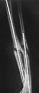 - - - - - Tab. 3. Morfologia stawu a œredni czas i odchylenie standardowe uzyskanego zrostu kostnego (miesi¹ce) Tab. 3. Morphology of the pseudarthrosis and mean time (standard deviation) to achieve union (in months) 616 Ryc.