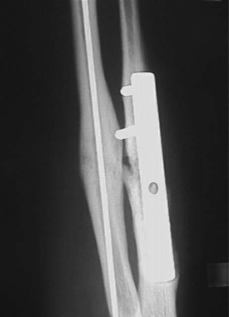 Fig. 1. Female patient MD, age 23, patient history no. 4690/05, radial bone, ulnar bone. a. time from fracture to decortication operation 12 months, b. bone bridge after 2 months, c.