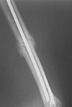 b. bone bridge after 5 months. c. bone union after 8 months siêcy.