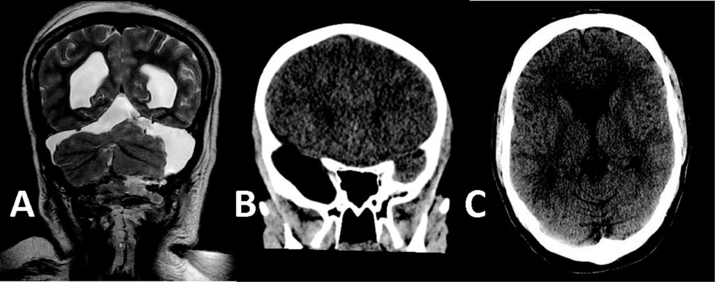 Wewnątrzczaszkowe torbiele pajęczynówki w aspekcie klinicznym i radiologicznym Ryc. 2 A-AC tylnego dołu czaszki w MR z następowym obturacyjnym wodogłowiem; przekrój czołowy.