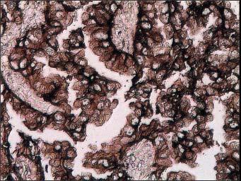 Badanie immunohistochemiczne (IHC) przeprowadzane w celu wykrycia ekspresji EGFR, w przypadku kwalifikacji chorych do leczenia TKI nie zawsze jest wiarygodne dla EGFR (nazywany też HER1, human