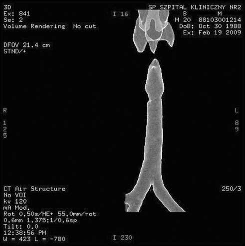 Tab. I. Ocena rozległości zwężeń krtaniowo-tchawiczych w badaniu SWTK 3D i śródope