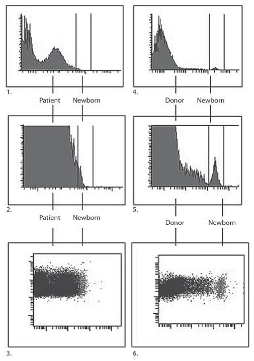 DNA analysis A Xmn Results Xmn Discussion Figure 1.