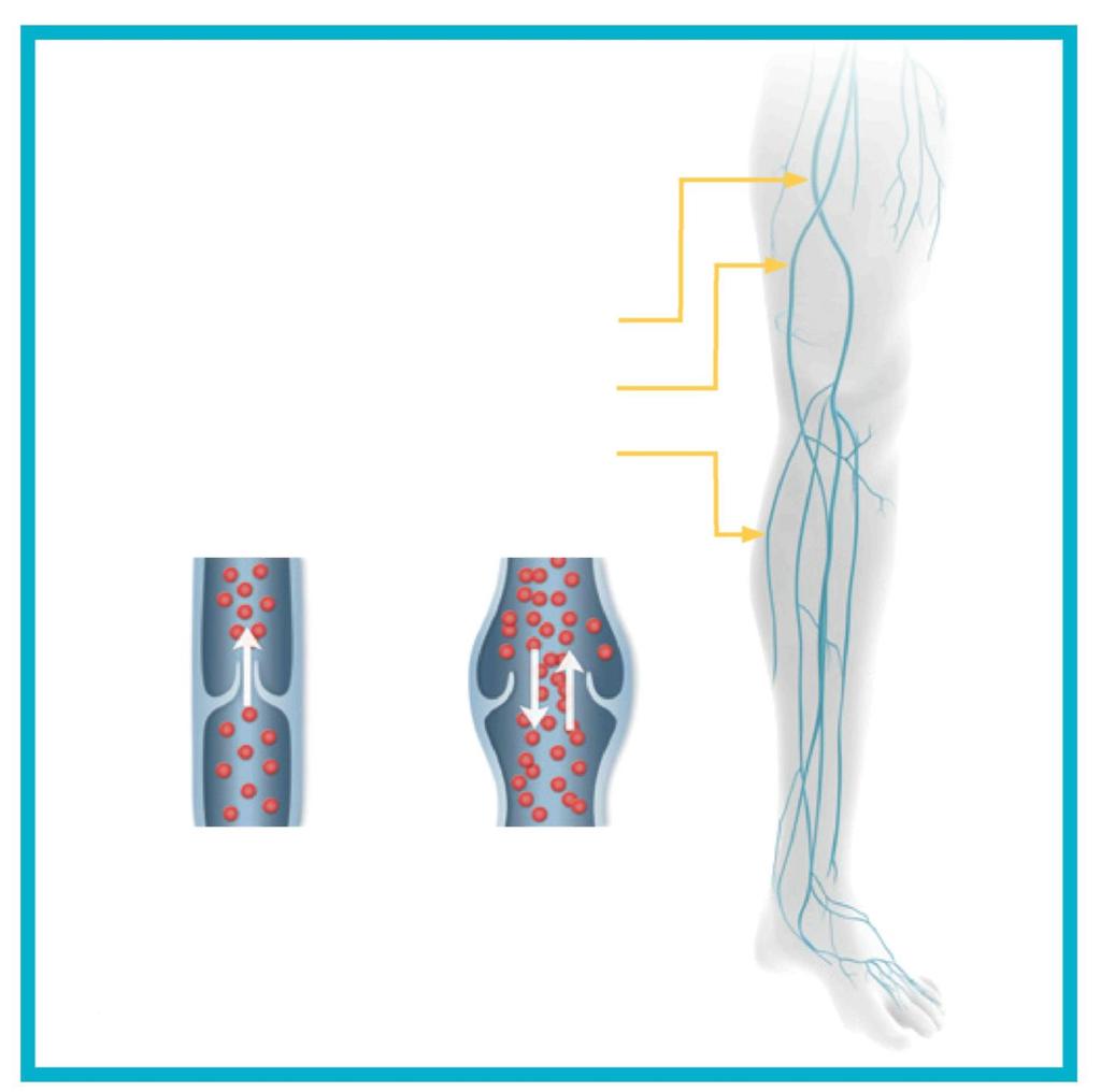 ANATOMIA ŻYŁ ŻYŁA UDOWA ŻYŁA ODPISZCZELOWA ŻYŁA ODSTRZAŁKOWA ZDROWA ŻYŁA Zastawki umożliwiają przepływ krwi tylko w jednym kierunku.