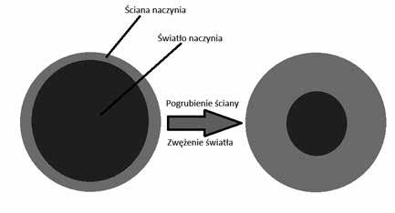 Zapobieganie zakażeniom Infekcje (zapalenie płuc) często doprowadzają do pogorszenia stanu ogólnego chorych i zgonu pacjenta.