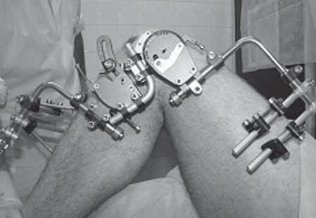 Rycina 6. Zgięcie stawu kolanowego z założonym stabilizatorem Dynastab K (Galileo). Figure 6. Knee flexion after the implantation of the Dynastab K (Galileo).