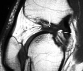 Zminy towrzyszåce uszkodzeniom wiæzdeæ krzyºowych w orzie rezonnsu mgnetycznego MRI evlution of lesions ssocited to ACL ters Zigniew Czyrny Crolin Medicl Center, Wrszw Streszczenie: W prcy