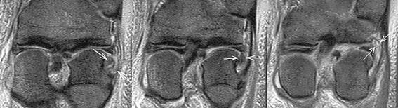 Stoller; Mgnetic Resonnce Imging in Orthopedics & Sports Medicine, Second Edition CD-ROM. Lippincott Wilims & Wilkins, Phildelphi, 1997 2. J.H. Mink, M.A.