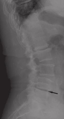Pomocne w procesie diagnostycznym mogą się również okazać badania czynnościowe w projekcji bocznej w pozycjach wyprostnej i zgięciowej kręgosłupa, które mogą ujawnić obecność kręgozmyku (przesunięcia