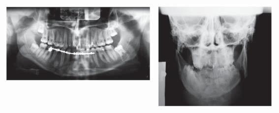 62 E. KLUCZEWSKA, M. ADWENT, M. CIEŚLIK, T. CIEŚLIK fractures.