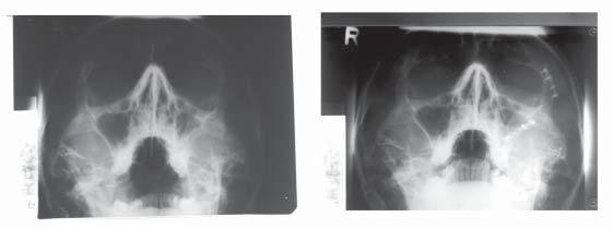 Additional projections is a performed in these situations; are PA RTG of mandible at open or closed mouth.