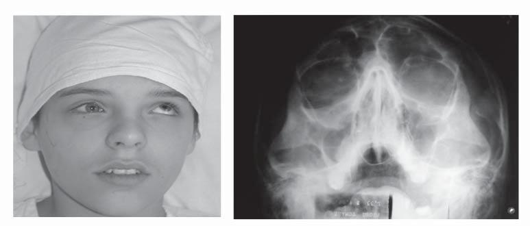 In our clinic pantomographic Rtg was performed almost in all patients after injuries of facial part of the skull.