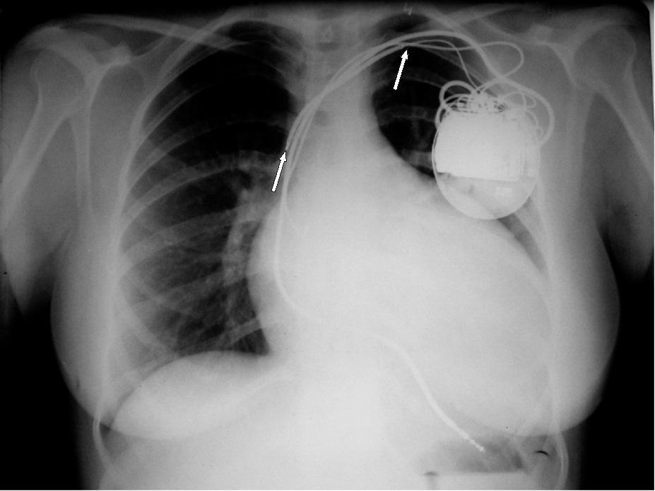 Folia Cardiologica Excerpta 2006, tom 1, nr 2 elektrody defibrylującej z 2 spiralami w koniuszku prawej komory oraz wykorzystaniu sprawnej elektrody stymulacyjnej w uszku prawego przedsionka