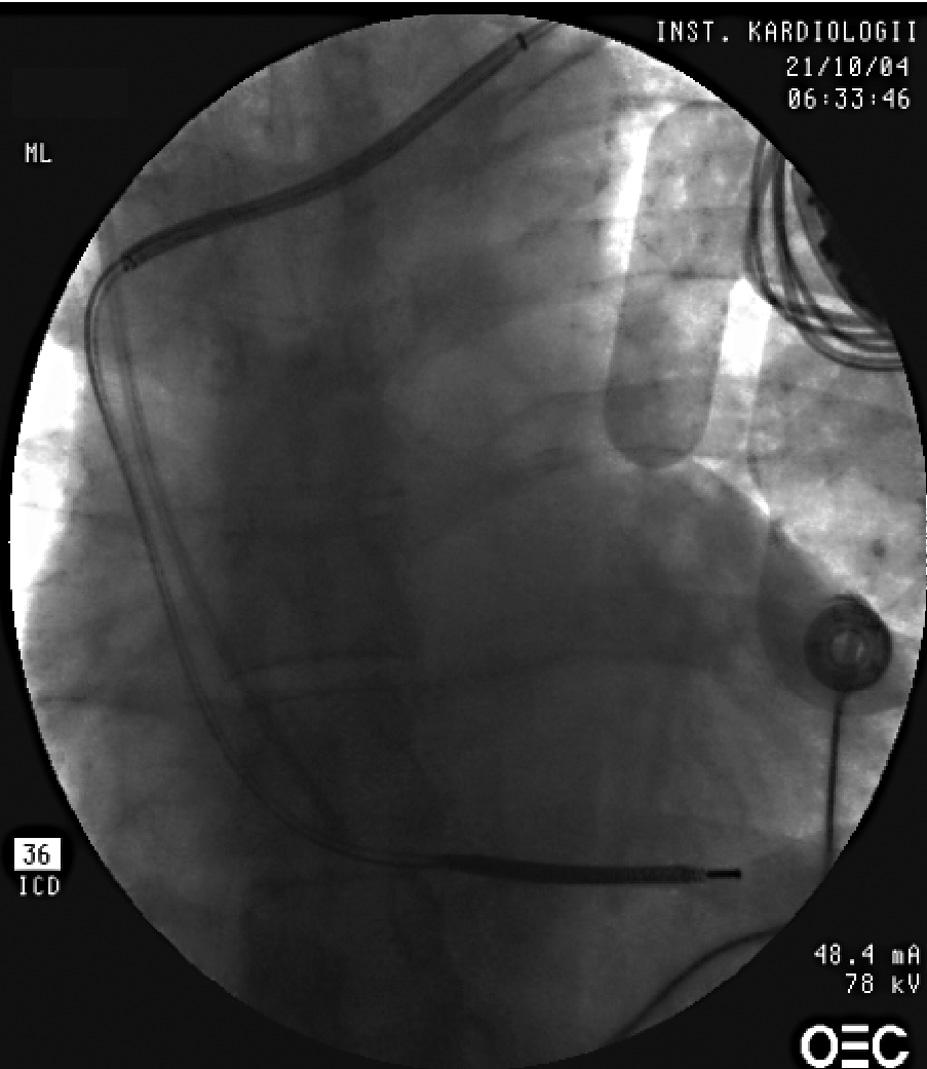 Folia Cardiologica Excerpta 2006, tom 1, nr 2 Rycina 5. Skopia rentgenowska.