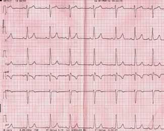 A B C D Rycina 1A i B. Elektrokardiogram dziecka z zespołem Fallota przed leczeniem operacyjnym: rytm zatokowy miarowy, prawogram, cechy przerostu prawej komory. C. Elektrokardiogram dziecka po leczeniu operacyjnym.