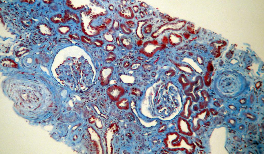7. Wrodzone zaburzenia metabolizmu witaminy B12 (kobalaminy), spowodowane mutacją genu MMAHC (Methyl-Malonic Aciduria and Homocystinuria type C) Dotyczą głównie noworodków.