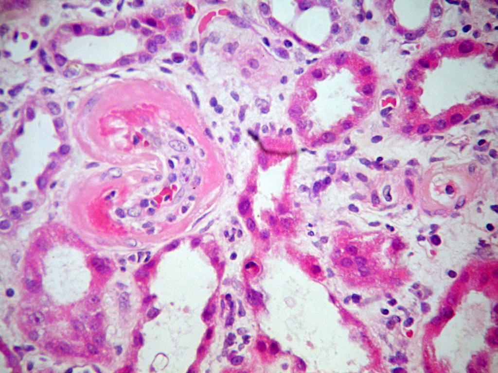 Wrodzone zaburzenia krzepnięcia (coagulation-mediated TMA) U pacjentów z mikroangiopatią zakrzepową zidentyfikowano uwarunkowane genetycznie nieprawidłowości trombomoduliny, plazminogenu oraz kinazy