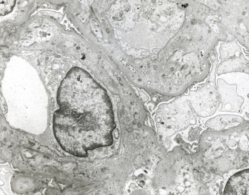 Rycina 7 Ostra mikroangiopatia zakrzepowa. Masywne obrzmienie rejonu podśródbłonkowego kapilar kłębuszkowych. Badanie w mikroskopii elektronowej. Acute thrombotic microangiopathy.
