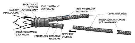1. Opis urządzenia System stentgraftu aorty brzusznej Ovation Prime ze stent-graftem biodrowym Ovation ix firmy TriVascular to wewnątrznaczyniowe urządzenie przeznaczone do leczenia tętniaków aorty