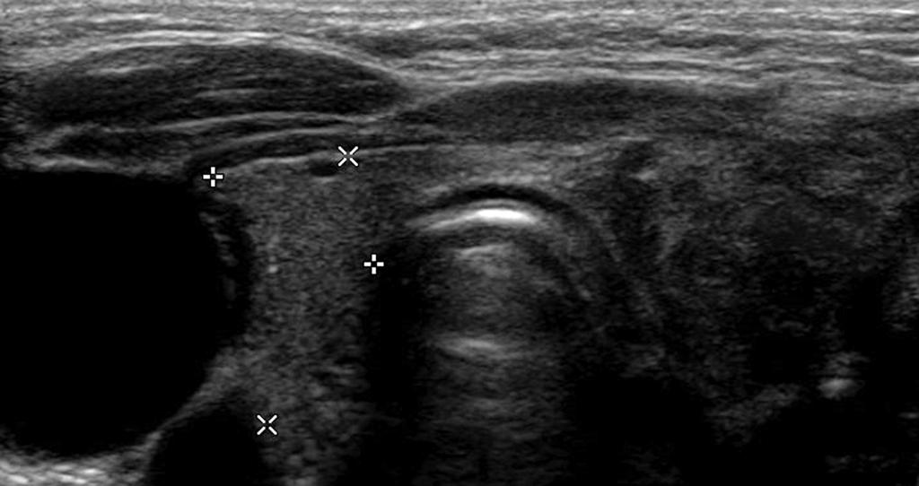 Ryc. 1. Usg tarczycy powiększony, zmieniony zapalnie lewy płat tarczycy Fig. 1. Usg of the thyroid gland enlarged, inflammable left lobe of the thyroid gland Ryc.