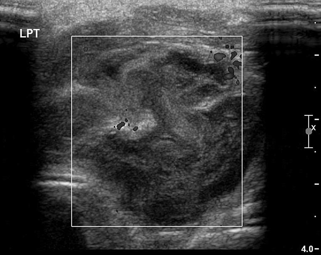 Usg of the thyroid gland - solid change in the left lobe of the thyroid gland, heterogeneous echogenicity with the evident poor vascularity inflammable