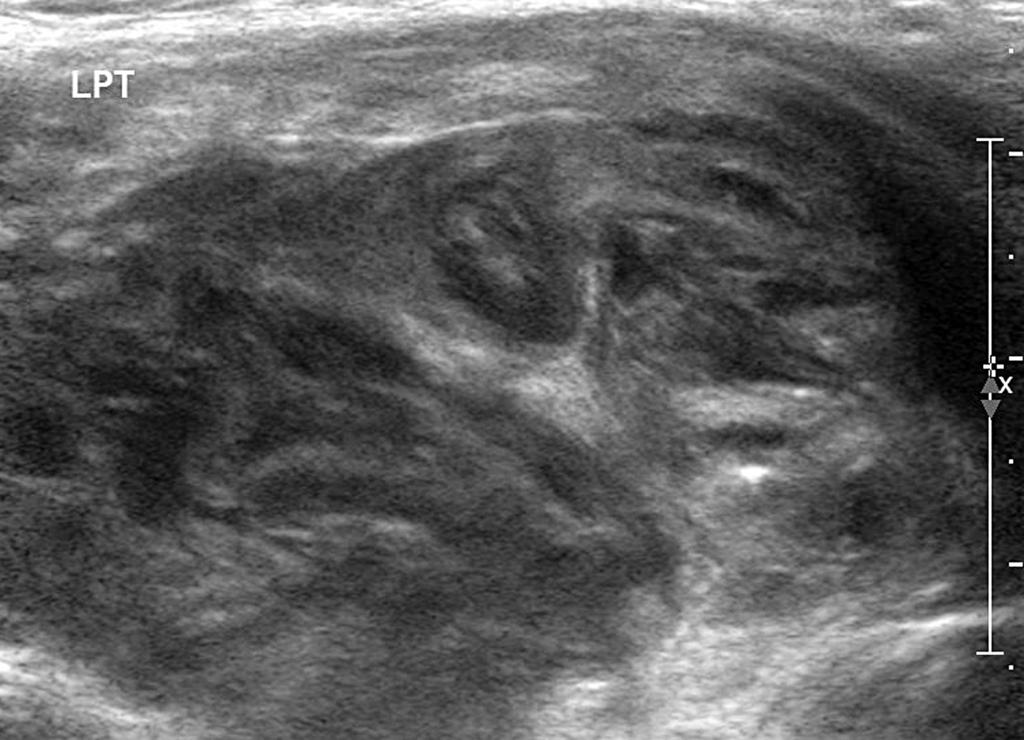 Ryc. 3. Usg tarczycy zmieniony zapalnie lewy płat tarczycy. Fig. 3. Usg of the thyroid gland changed inflammable left lobe of the thyroid gland Ryc.