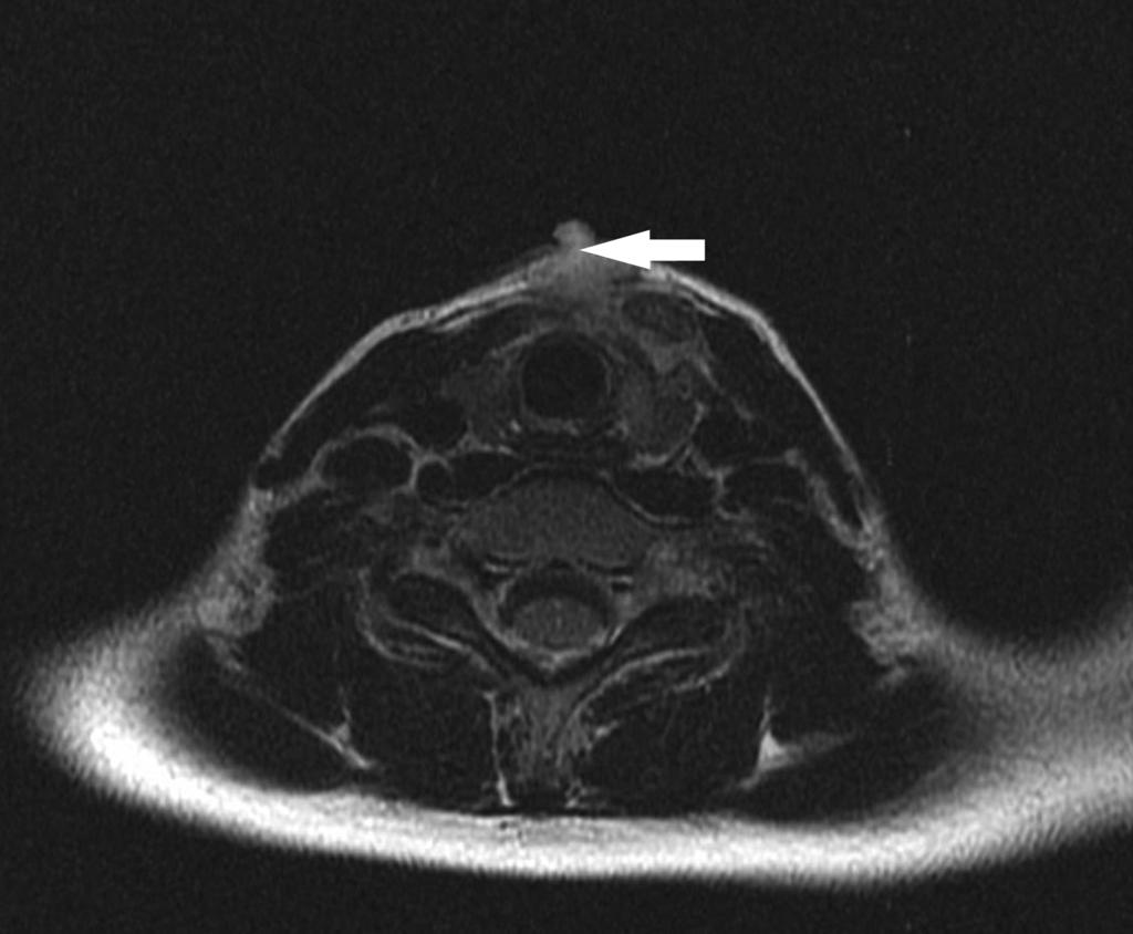 NMR of the neck centre cyst of the neck with the skin fistula 52 Endokrynol. Ped. 2017.16.1.58.