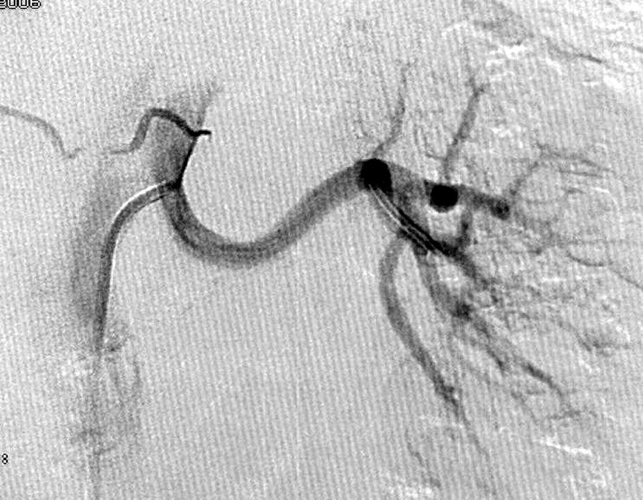 Robert Juszkat i wsp., Udana ewakuacja stentu z tętnicy nerkowej przemieszczonego podczas PCI stentu z lewej tętnicy nerkowej, a następnie z tętnicy głębokiej uda.