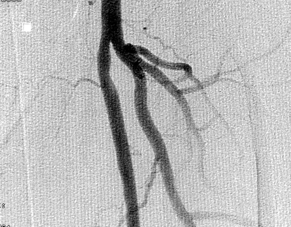 Folia Cardiologica Excerpta 2007, tom 2, nr 1 Rycina 2. Próba ewakuacji stentu za pomocą pętli lasso Rycina 4.