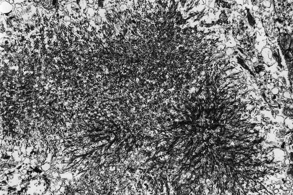 amyloidowych; (b) rdzenie amyloidowe