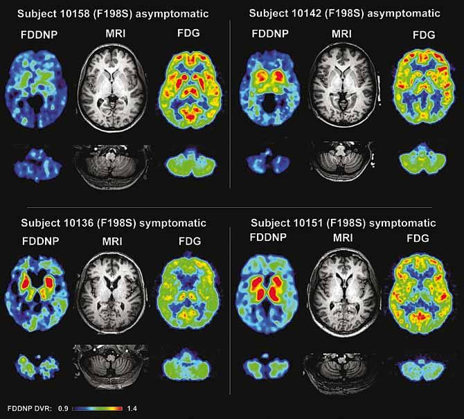 PrP-immunoreaktywnych depozytów w korze mózgu, jednoi wielordzeniowe blaszki oraz zwyrodnienie włókienkowe Alzheimera (98). Nie obserwowano zmian gąbczastych.