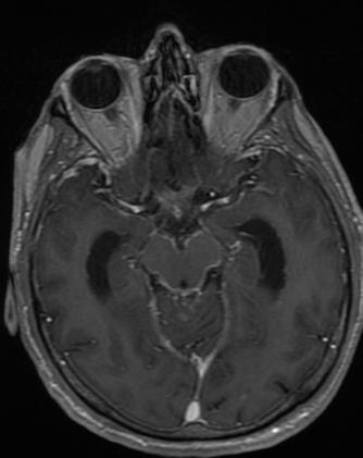 (GBM, ependymoma,