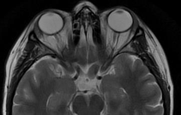 Astrocytoma pilocyticum Droga wzrokowa/podwzgórze (optic/chiasmatic/hypothalamic) Poszerzenie nerwów