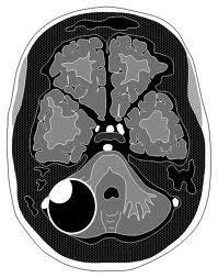 Astrocytoma pilocyticum Móżdżek (dzieci) > mózg (dorośli) 50% zmiana torbielowata z silnie wzmacniającym się guzkiem