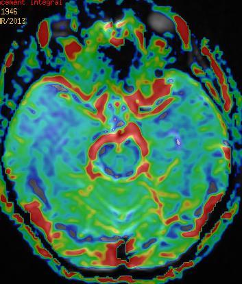 Astrocytoma