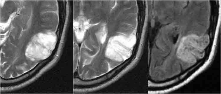 DNET dysembryoplastic neuroepithelial tumor (WHO I) Guz wewnąrzkorowy, współistnieje z dysplazją korową Często obraz guza z psuedotorbielkami (bubbly
