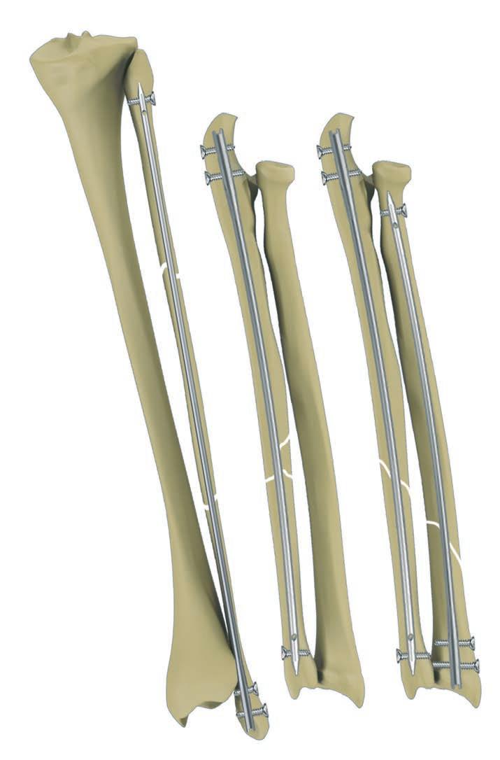 ST/07D ŚRÓDSZPIKOWA OSTEOSYNTEZA