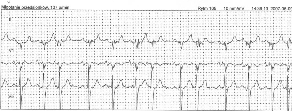 Choroby Serca i Naczyń 2011, tom 8, nr 3 Rycina 5. Opis 24-godzinnego badania EKG Rycina 6.